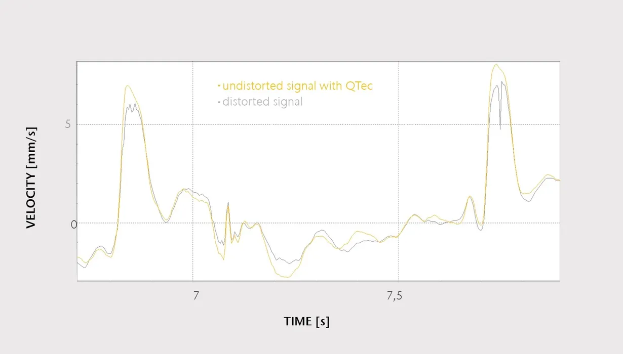 Bild 5:	Bei der Pulsmessung verursacht die seitliche Bewegung der Haut aufgrund der Patientenbewegung und der Druckschwankungen in der Halsarterie normalerweise Flecken (Speckle). Bei der neuen Technologie dagegen ist das Signal-Rauschverhältnis deutlich besser und das Messsignal wird auch durch Aussetzer nicht beeinflusst. (Urheber: Polytec)